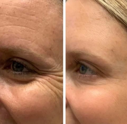 Botox/Dysport/Xeomin/Daxxify - BeautyWoRX Bardstown